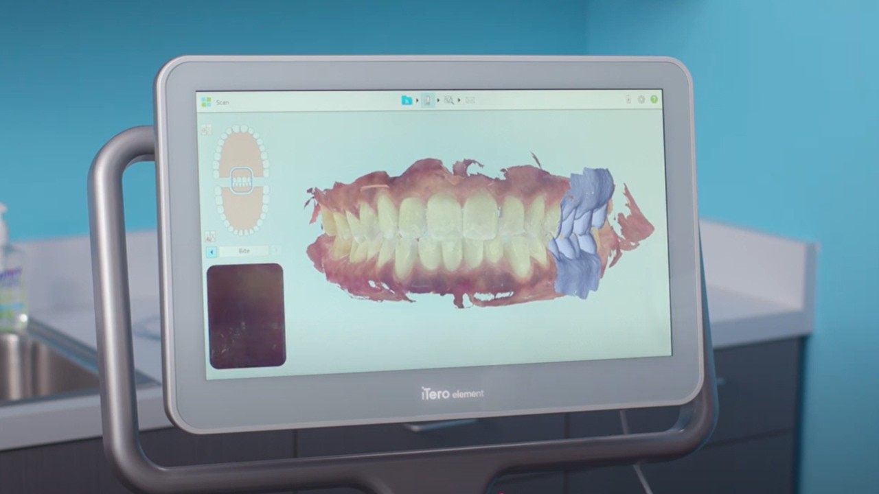 iTero Element&trade; 2 scanner: tips on maximizing your digital scanning protocol