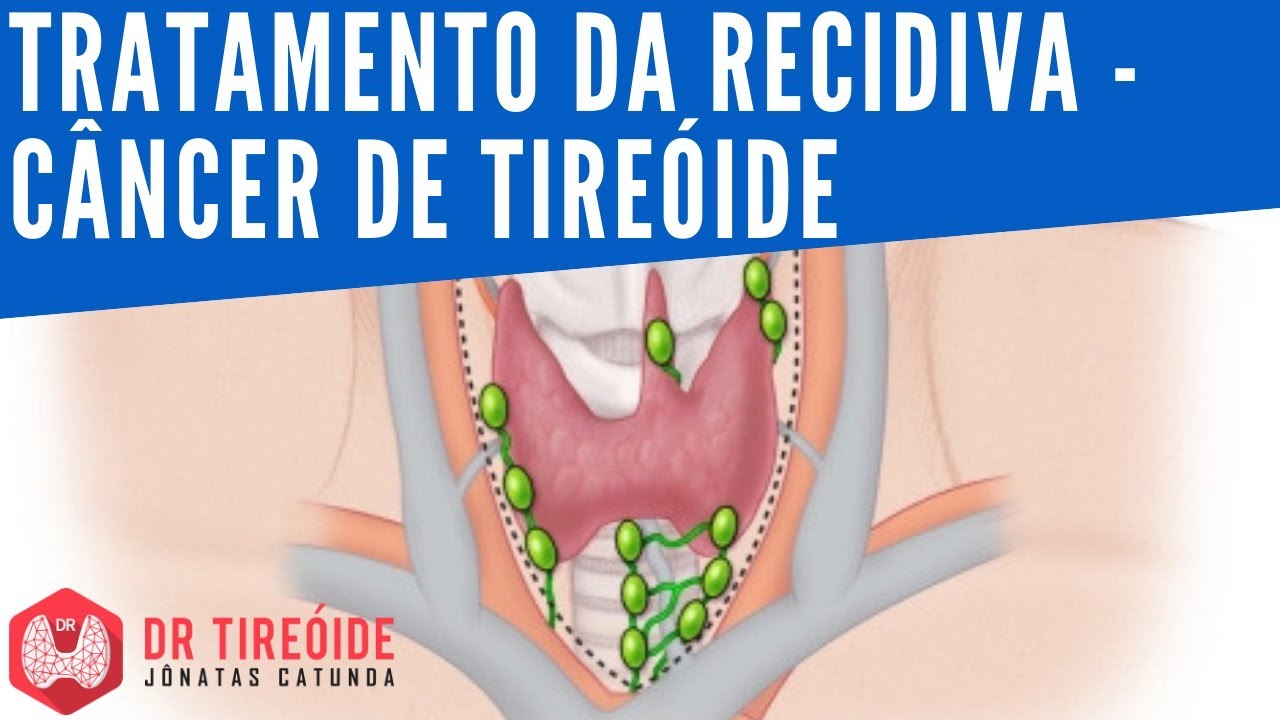 🔴 Tratamento da recidiva do câncer de tireóide | Dr Tireóide Responde #63#