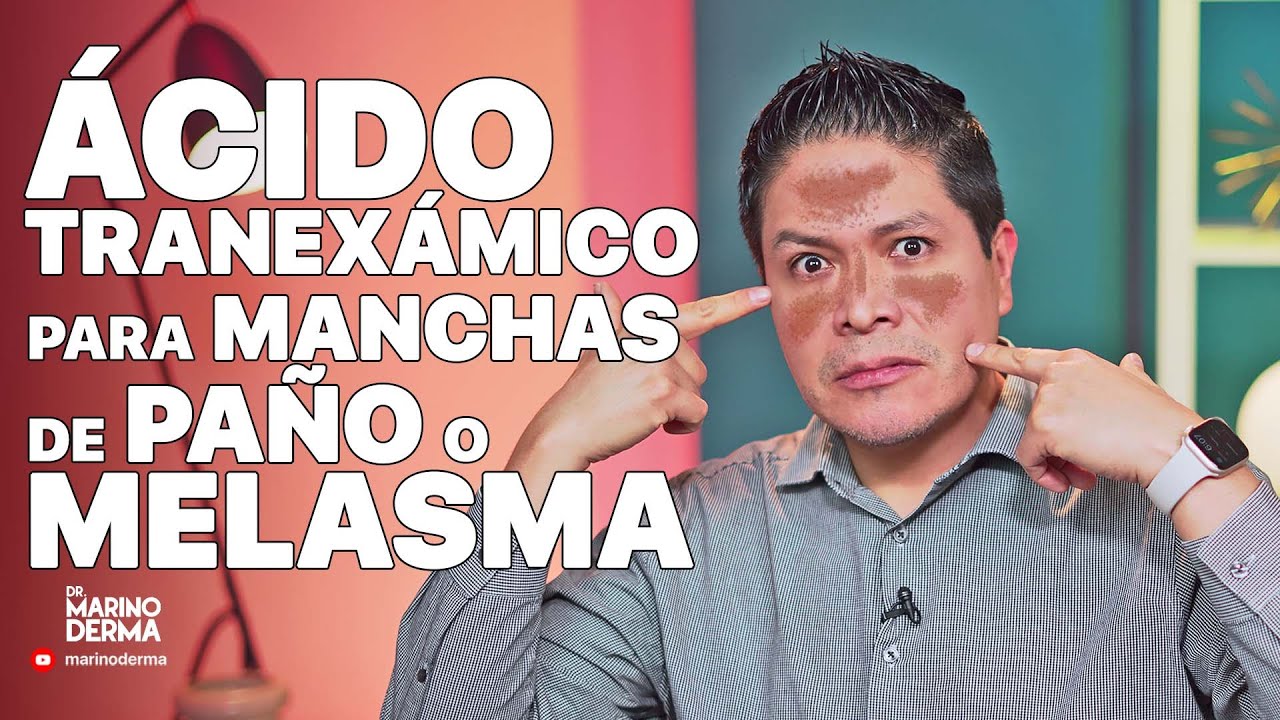 ACIDO TRANEXAMICO PARA MANCHAS EN LA CARA DE TIPO PAÑO O MELASMA