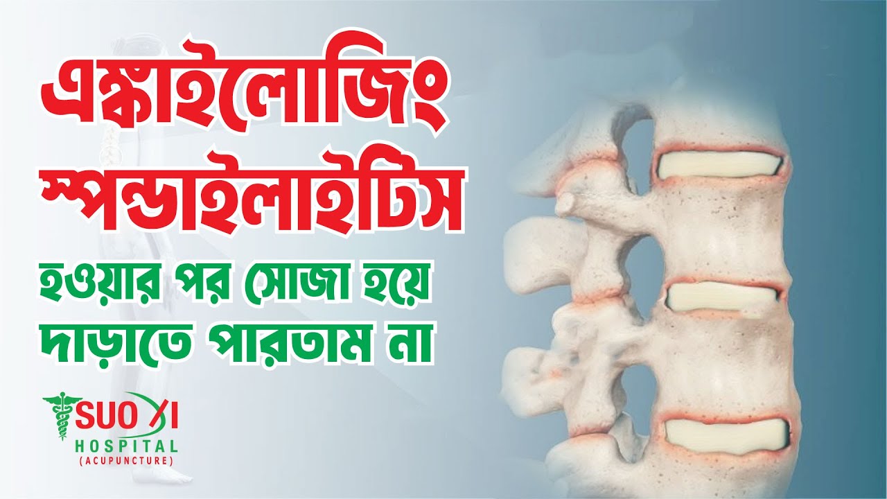 আকুপাংচার এর মাধ্যমে এঙ্কাইলোজিং স্পন্ডাইলাইটিস রোগের চিকিৎসা করে সুস্থ্যতা পেয়েছি |