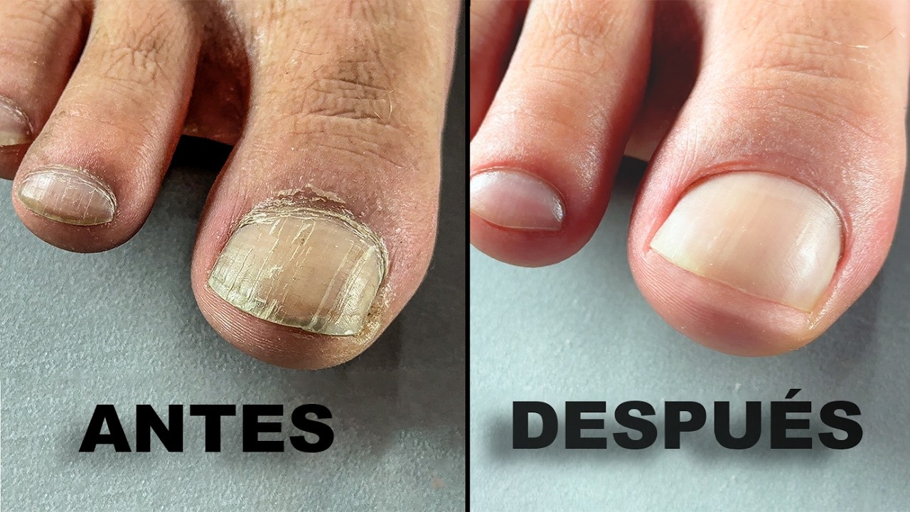 🙋‍♀️¡Hasta la vista molestias en las uñas-NUEVO método de pedicura japonesa | Transformación de uñas