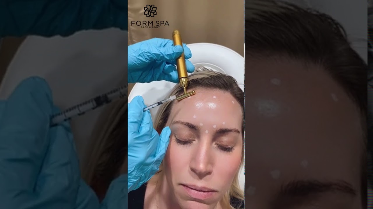 Glabellar Injections