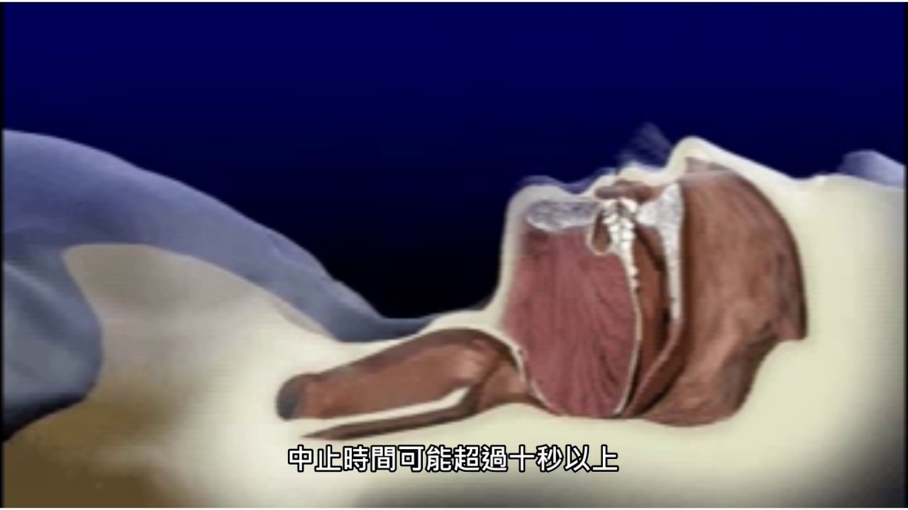 睡眠呼吸中止介紹