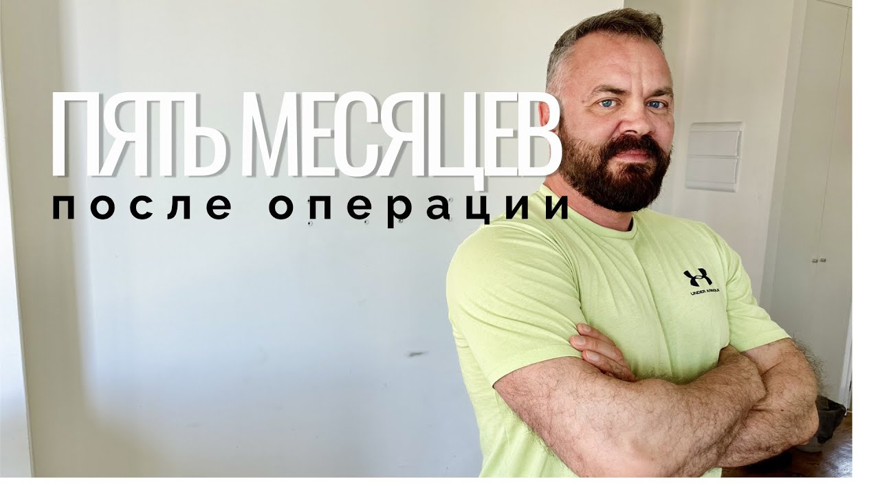 Пересадка волос: пять месяцев после операции