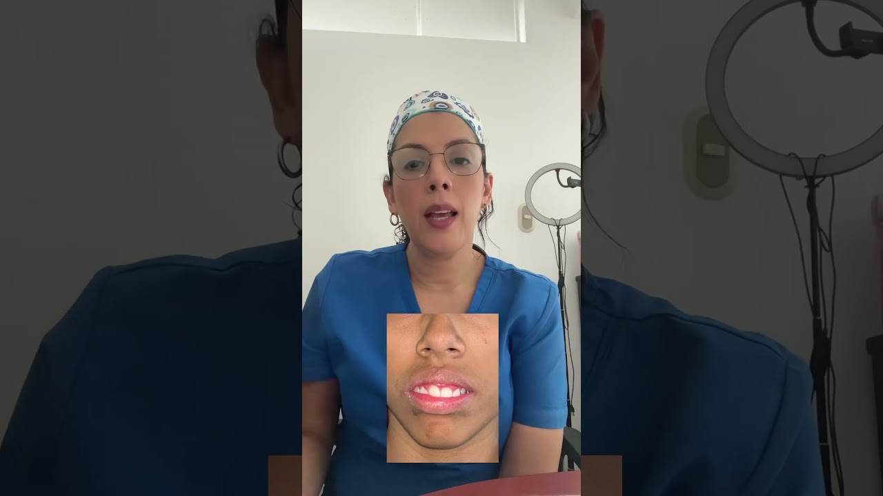 Incompetencia Labial                       #dentista #bracket #myobrace#invisalign #brackets