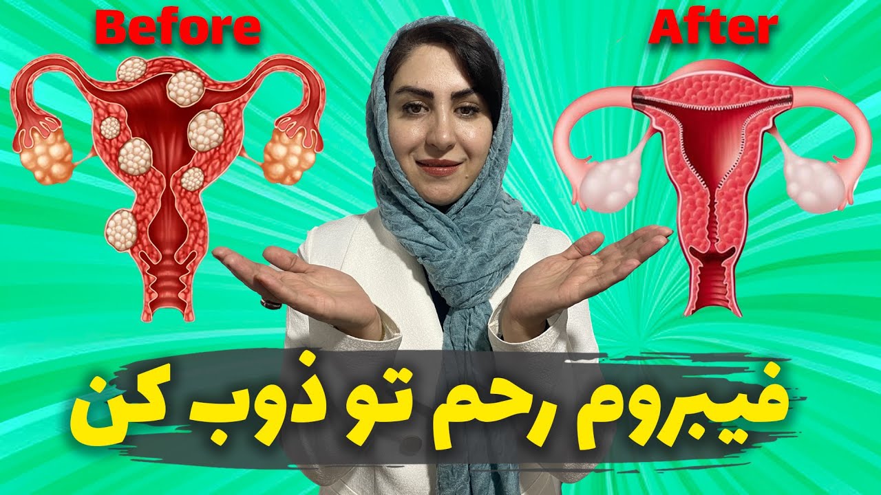 درمان قطعی فیبروم رحم در کمتر از 40 روز! : درمان فیبروم رحم بدون تزریق آمپول و جراحی