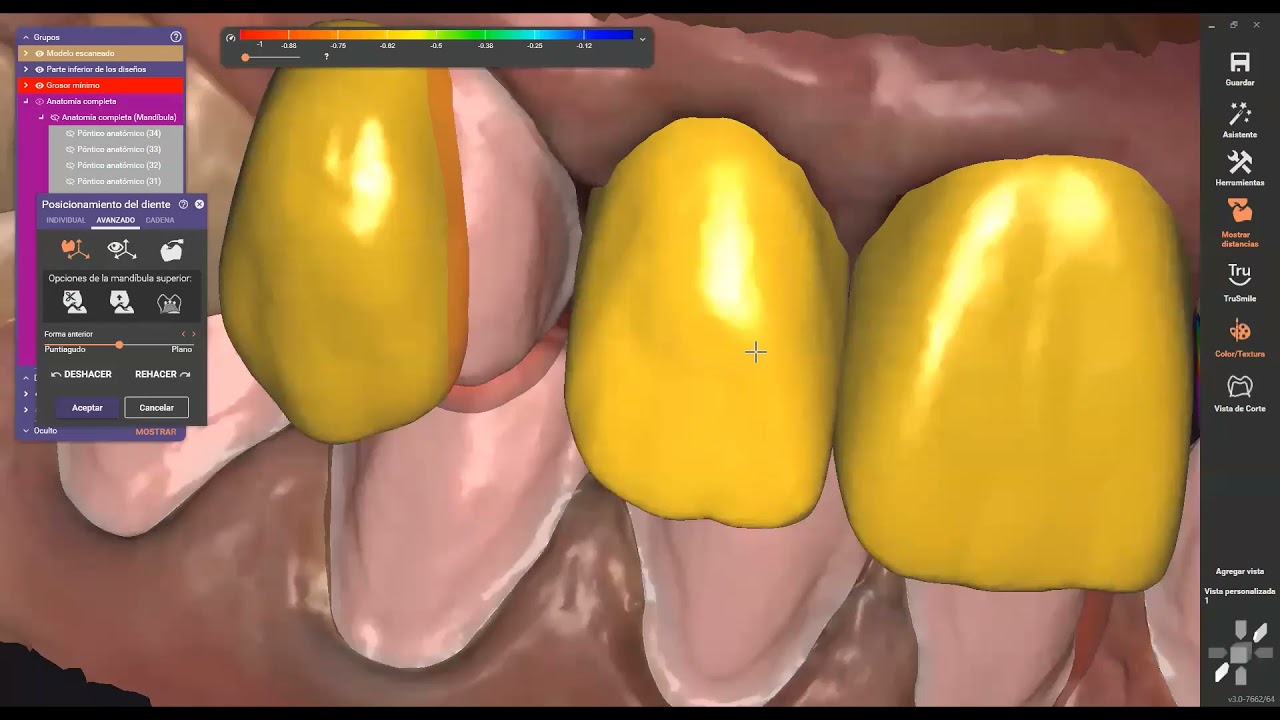 Carillas y coronas superior e inferior exocad