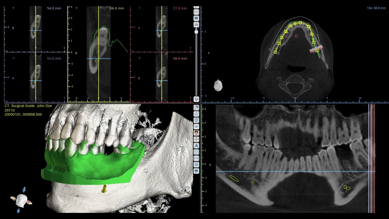 Surgical guide digital fabrication
