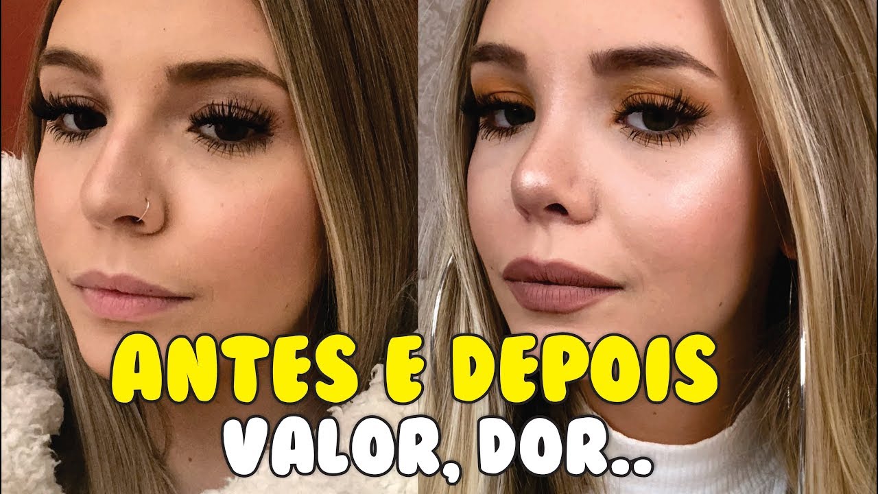 MINHA RINOPLASTIA: PREÇO, MÉDICO, DOR?!