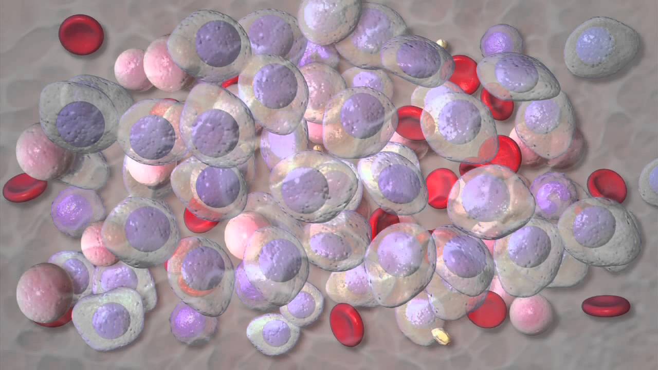 Surviving Multiple Myeloma - Mayo Clinic