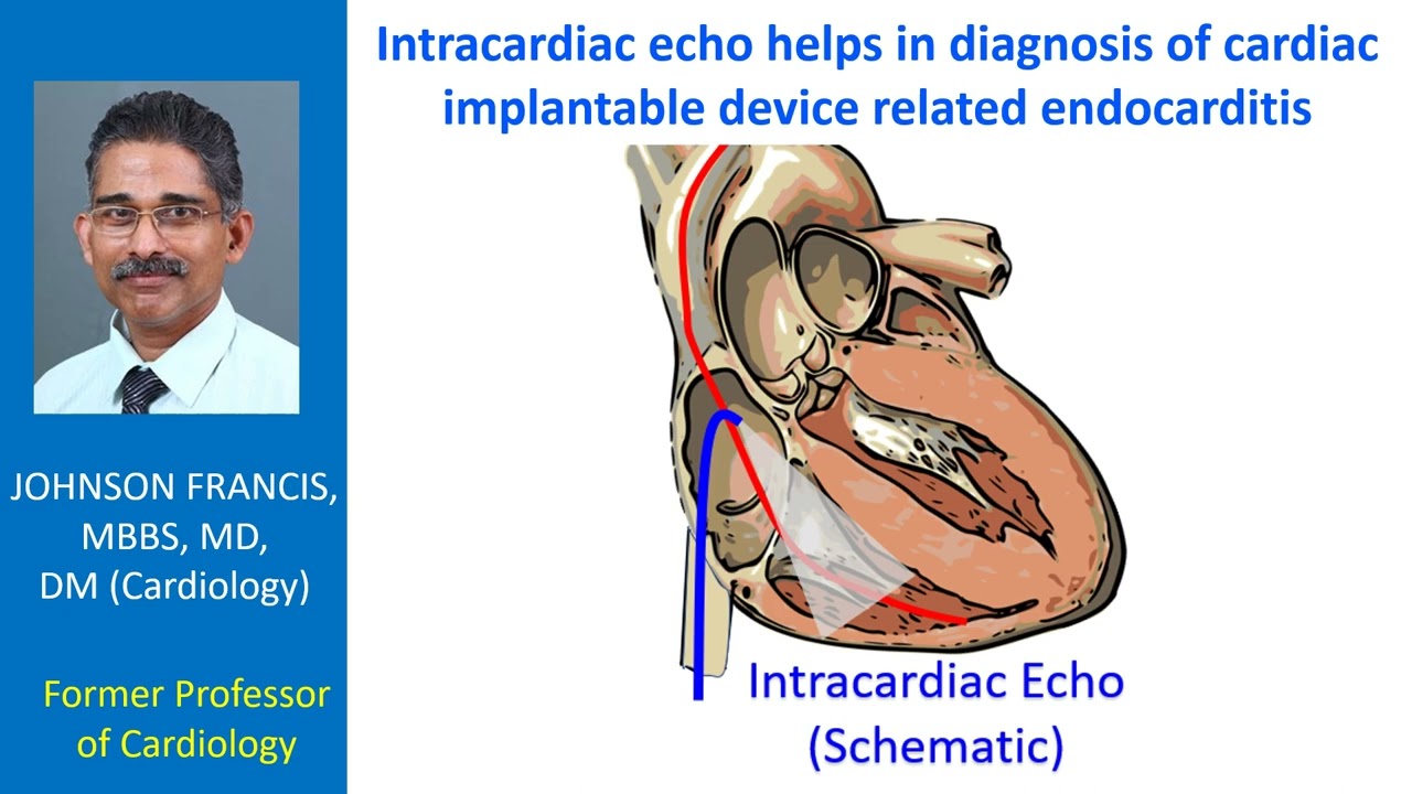 Intracardiac echo helps in diagnosis of cardiac implantable device related endocarditis