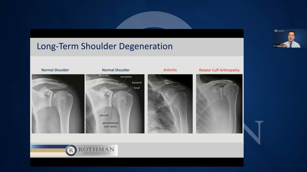 Innovations In Shoulder Replacement - A Lecture from Dr. Daniel Goltz