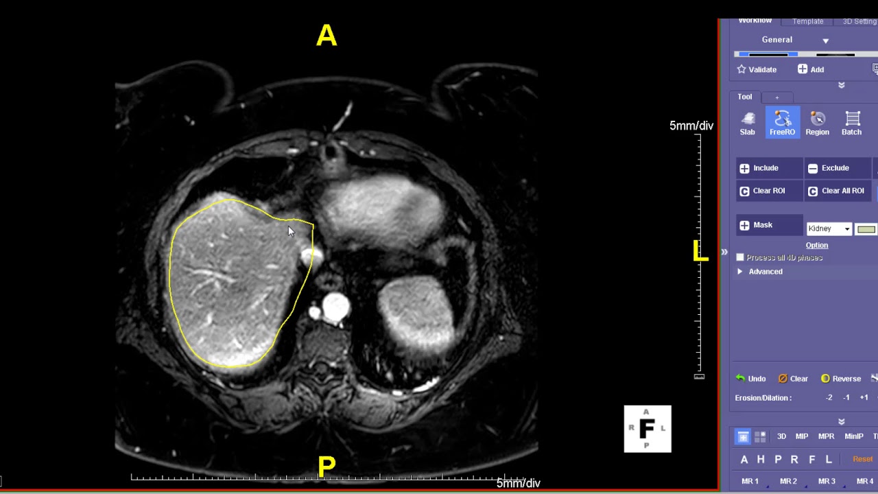 How to do Liver Volumes