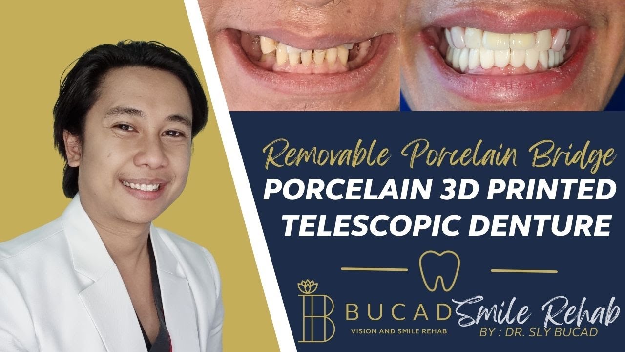 REMOVABLE BRIDGE TELESCOPIC PEEK PORCELAIN DENTURE Best Dental Optical Clinic Manila Philippines