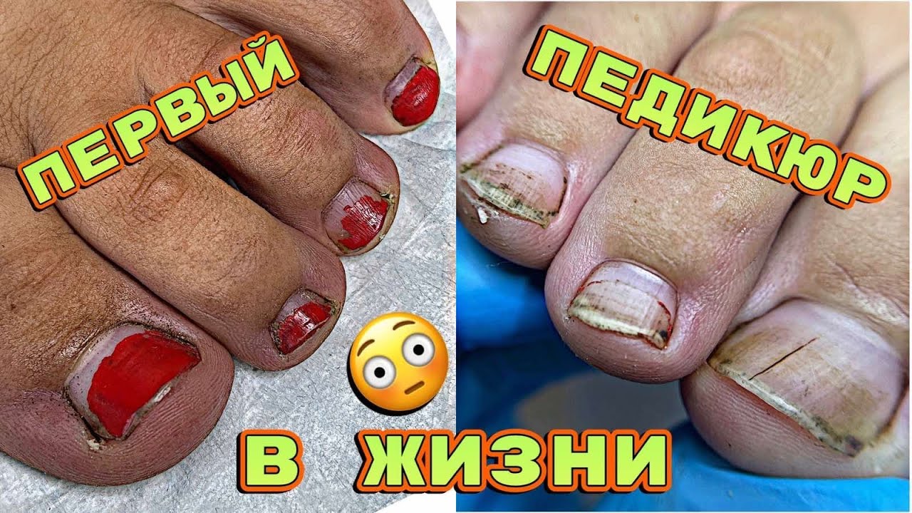 Желтые ногти 😨 Педикюр впервые в жизни 💅 Обработка ногтей