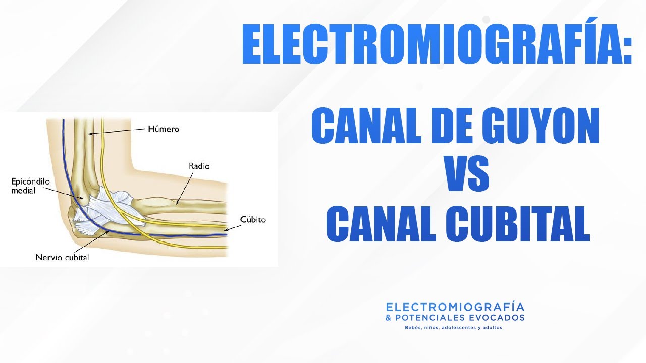 ELECTROMIOGRAFÍA: CANAL DE GUYON VS CANAL CUBITAL