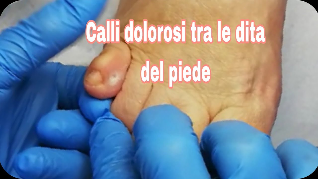 Pedicure dry e calli🤕 #calli #dolorosi #piede #armoniadonna #catania