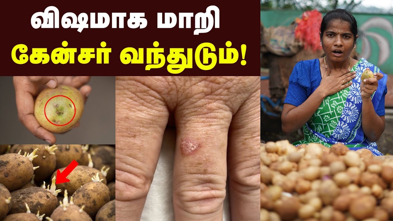 Health benefits: உருளைக்கிழங்கு இப்படி வாங்குனா ஆப்பு தான்| Potato chips | Potato Fry Recipe