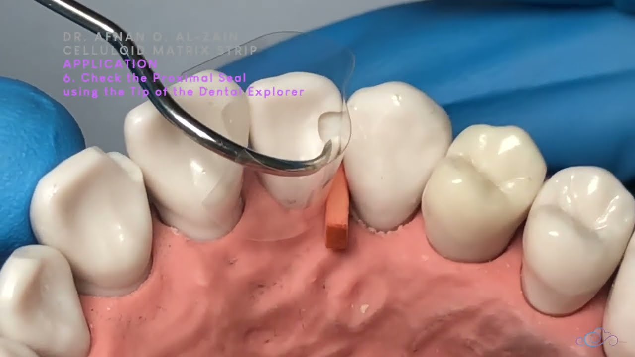 Celluloid matrix strip application & Removal - Arabic عربي