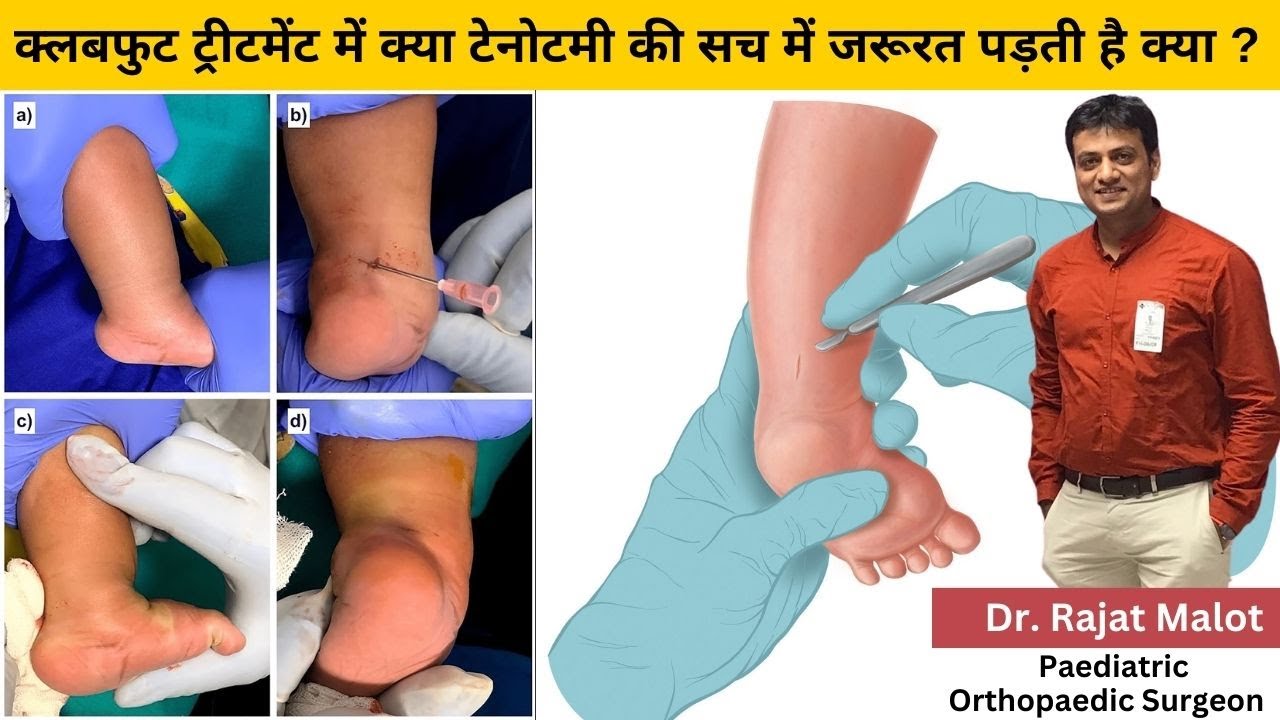 क्लबफुट ट्रीटमेंट में क्या टेनोटमी की सच में जरूरत पड़ती है क्या ? अकिलीज टेनोटमी