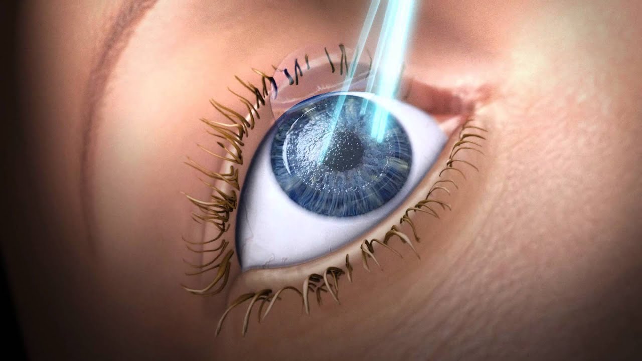 3D-Animation f&uuml;r SCHWIND eye-tech-solutions GmbH & Co. KG