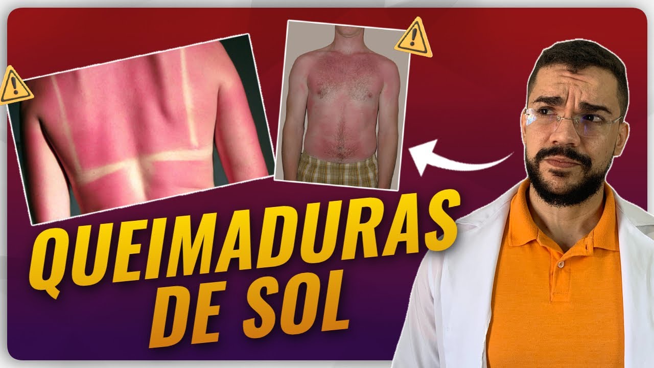 Tudo Que Voc&ecirc; Precisa Saber Para Tratar Queimadura de Sol