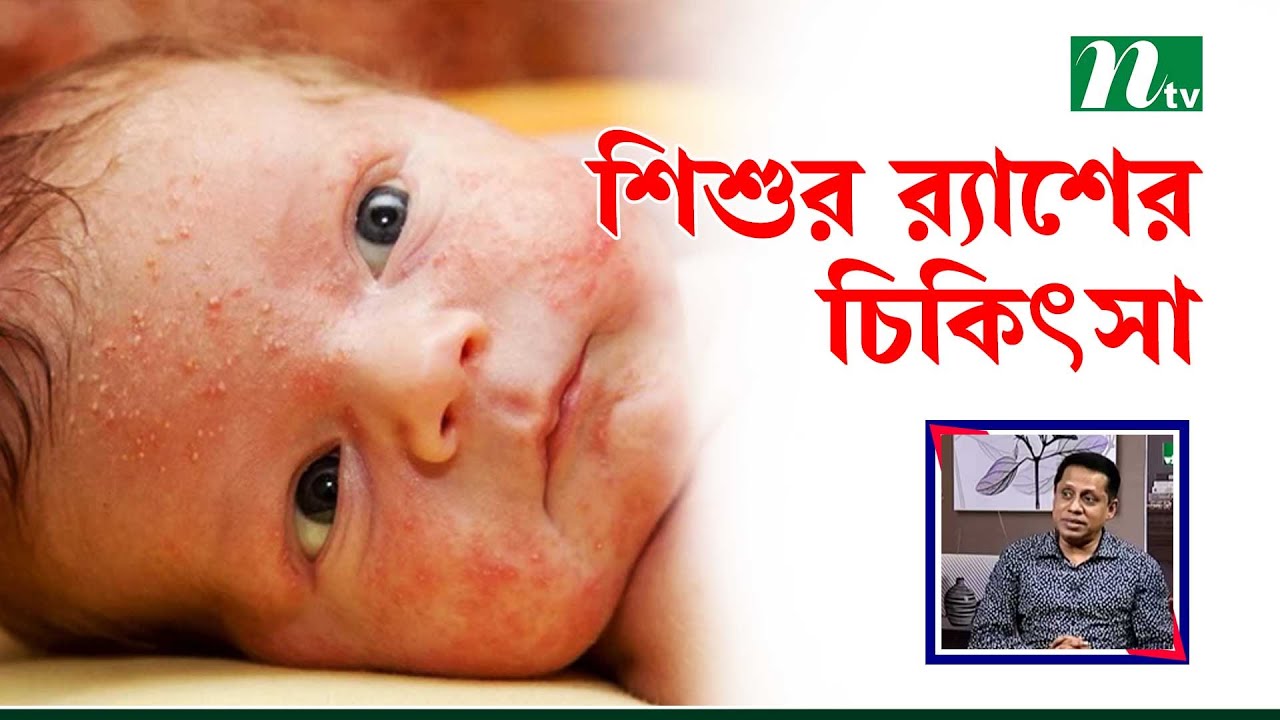 শিশুদের শরীরে র‍্যাশ হলে এর চিকিৎসা পদ্ধতি।  Health Show | স্বাস্থ্য প্রতিদিন |