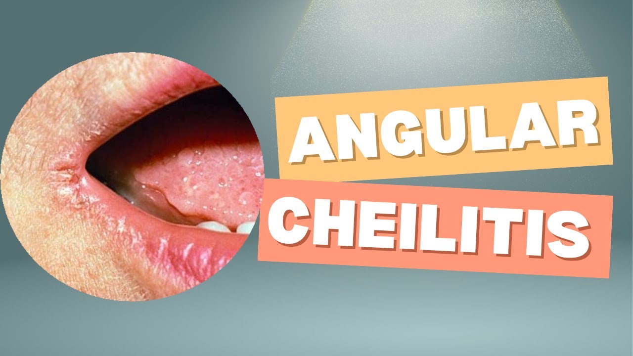 Angular Cheilitis Explained | Causes, Symptoms & Treatment (From A to Z Derma)