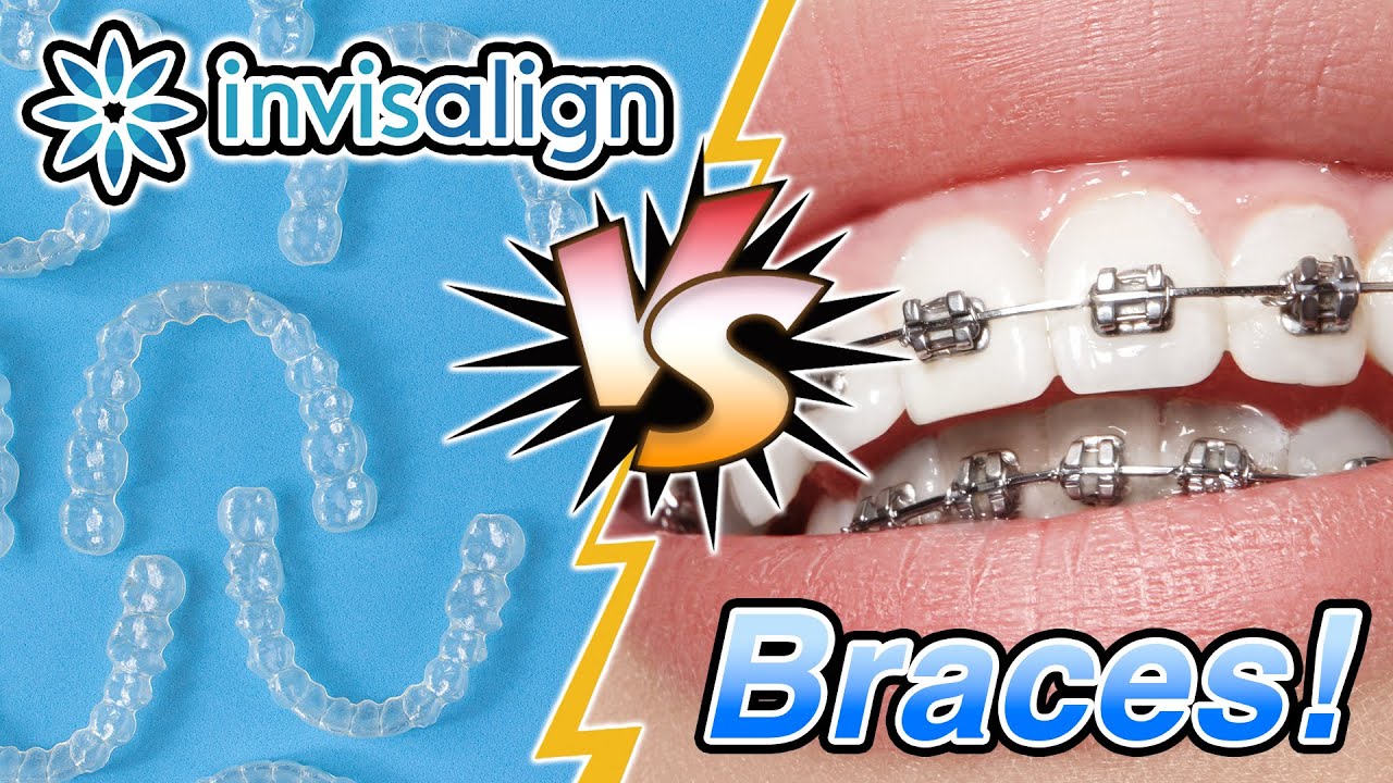 Braces Vs. Invisalign [What's Best For You?] | Premier Orthodontics
