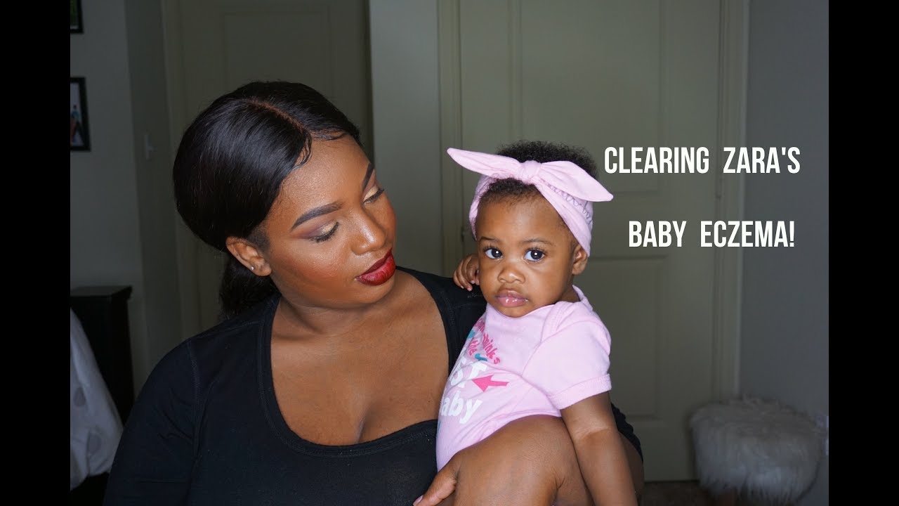 HOW I CLEARED ZARA'S BABY ECZEMA WITHOUT MEDICINE