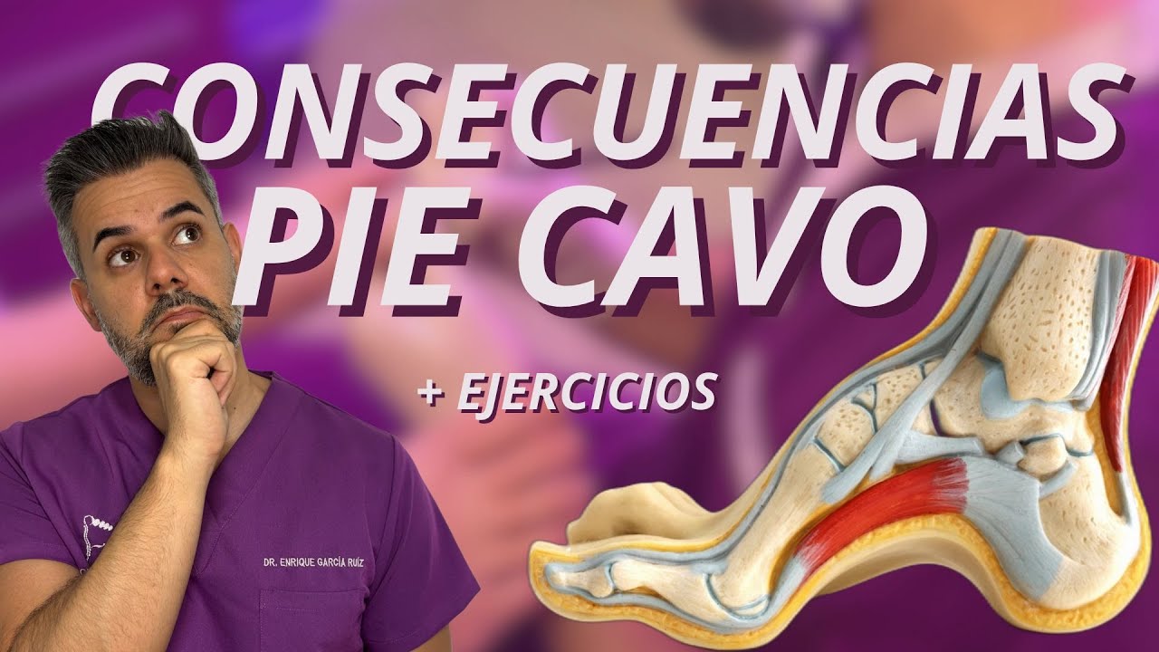 PIE CAVO + 💪 EJERCICIOS para mejorar su funcionalidad