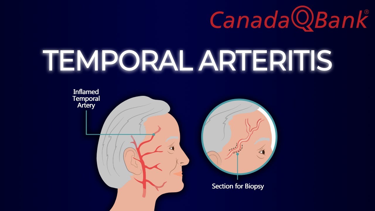 Temporal Arteritis