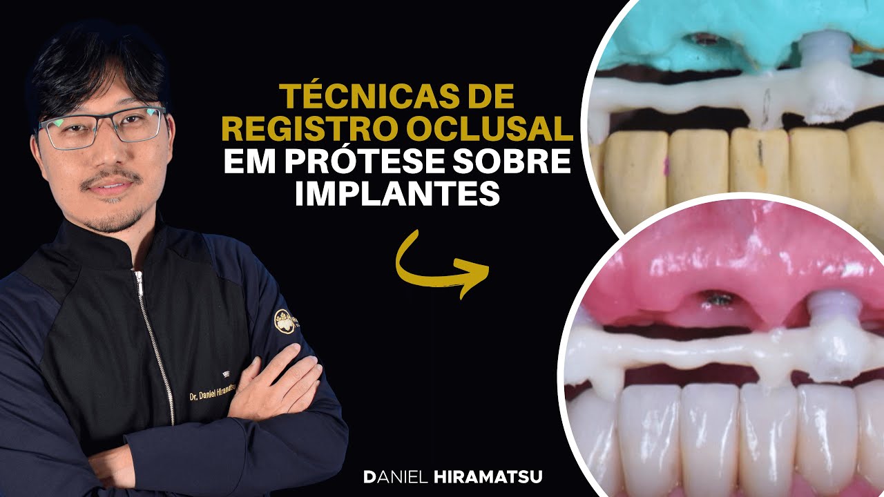 Técnicas de Registro Oclusal em Prótese sobre Implantes