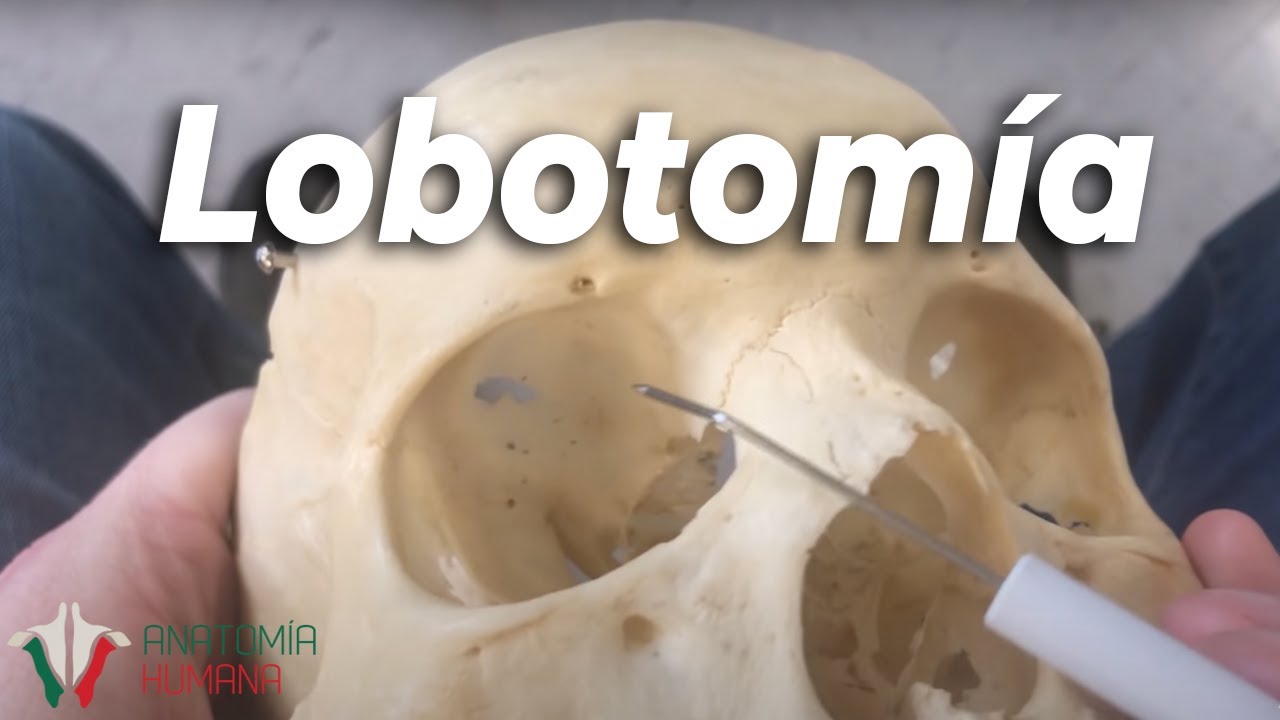 La anatomía de la Lobotomía