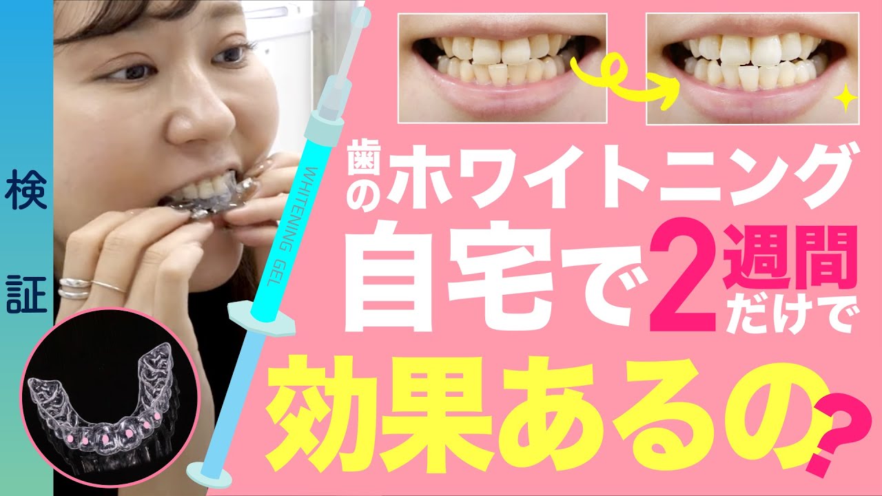 【歯科】セルフホワイトニングはどのくらい続けたら白くなる？ホームホワイトニング効果＊検証＊
