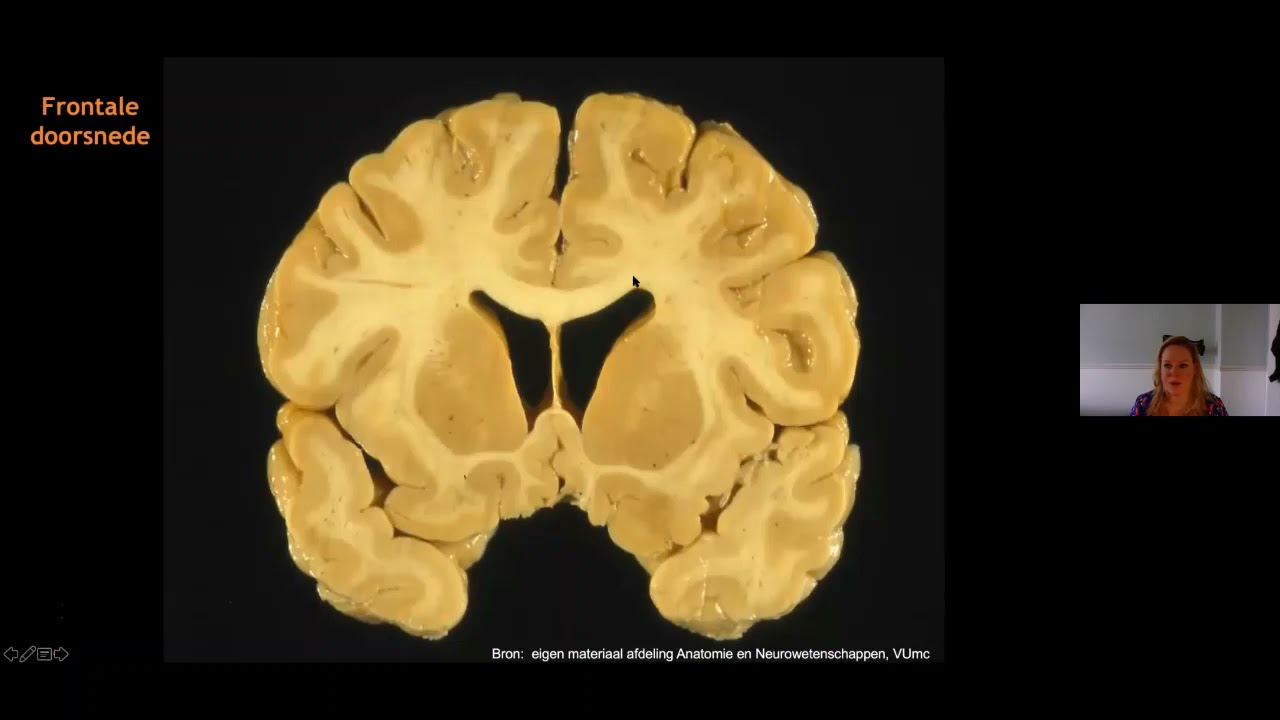 MS Cognitie Lunch maart 2021 -  deel 2: Cognitieve stoornissen en de relatie met hersenschade