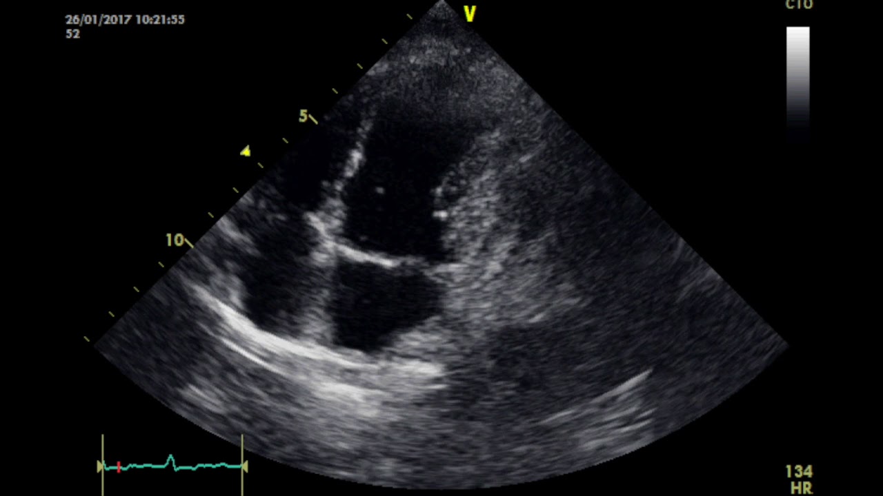 Erhlichiosis y Taponamiento Cardiaco