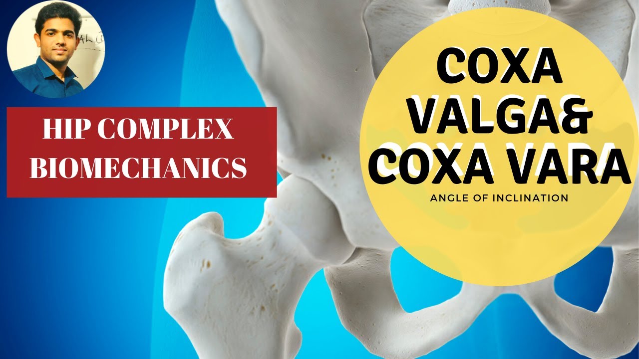 Angle of Inclination |Coxa Valga | Coxa Vara- (Hip Biomechanics)