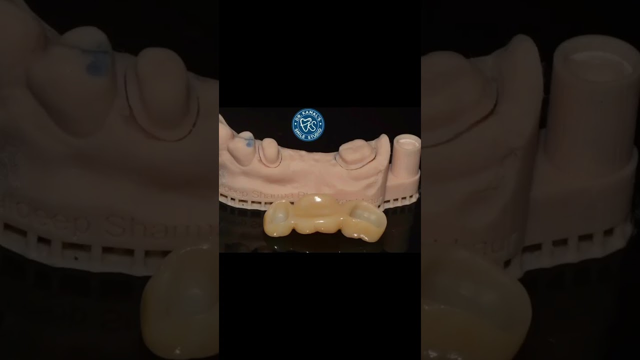 Zircad prime Emax crowns. Beauty and strength at its best❤️ #prosthodontist #dentalcentre #dentist