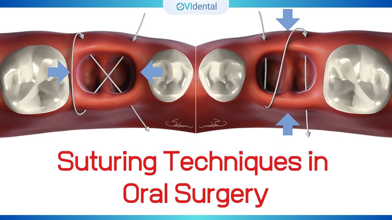 ► Suturing Techniques in Oral Surgery