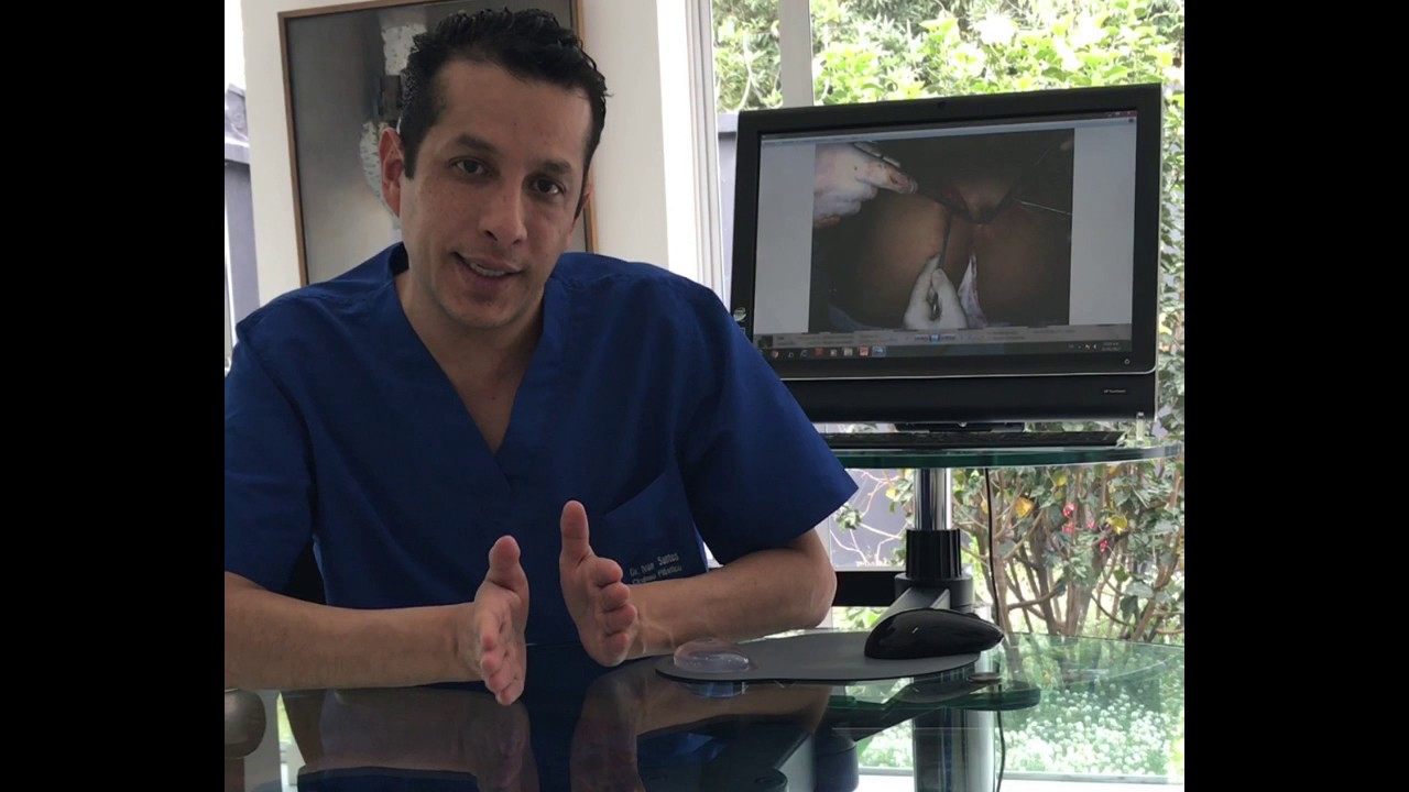 Retiro polímeros en espalda | Dr. Ivan Santos - Cirugía plástica en Colombia |