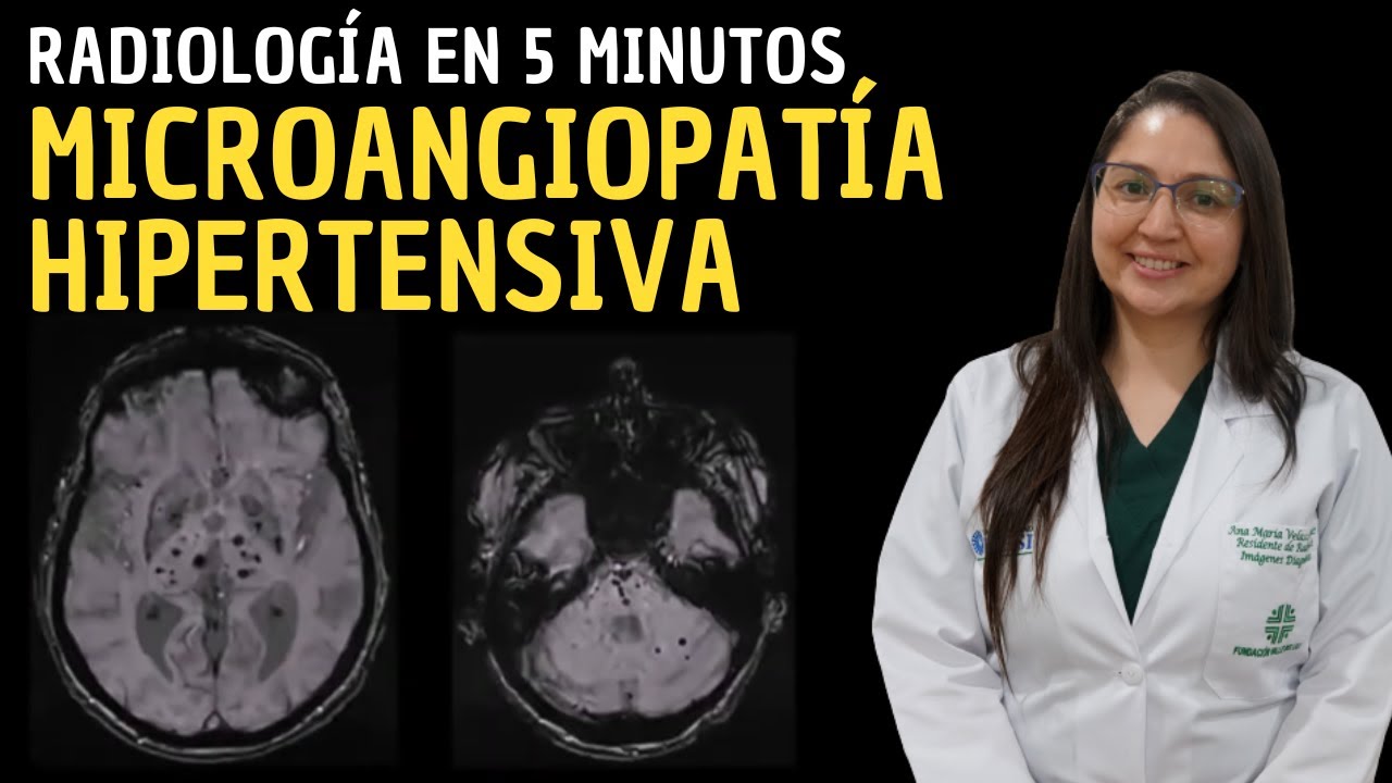Microangiopatía Hipertensiva: Radiología en 5 minutos.