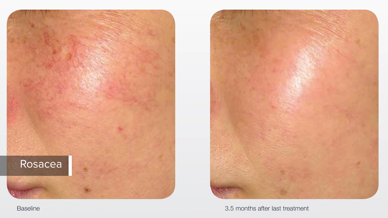 Lumenis M22 IPL Skin Rejuvenation + Thread Vein Removal (High Res)