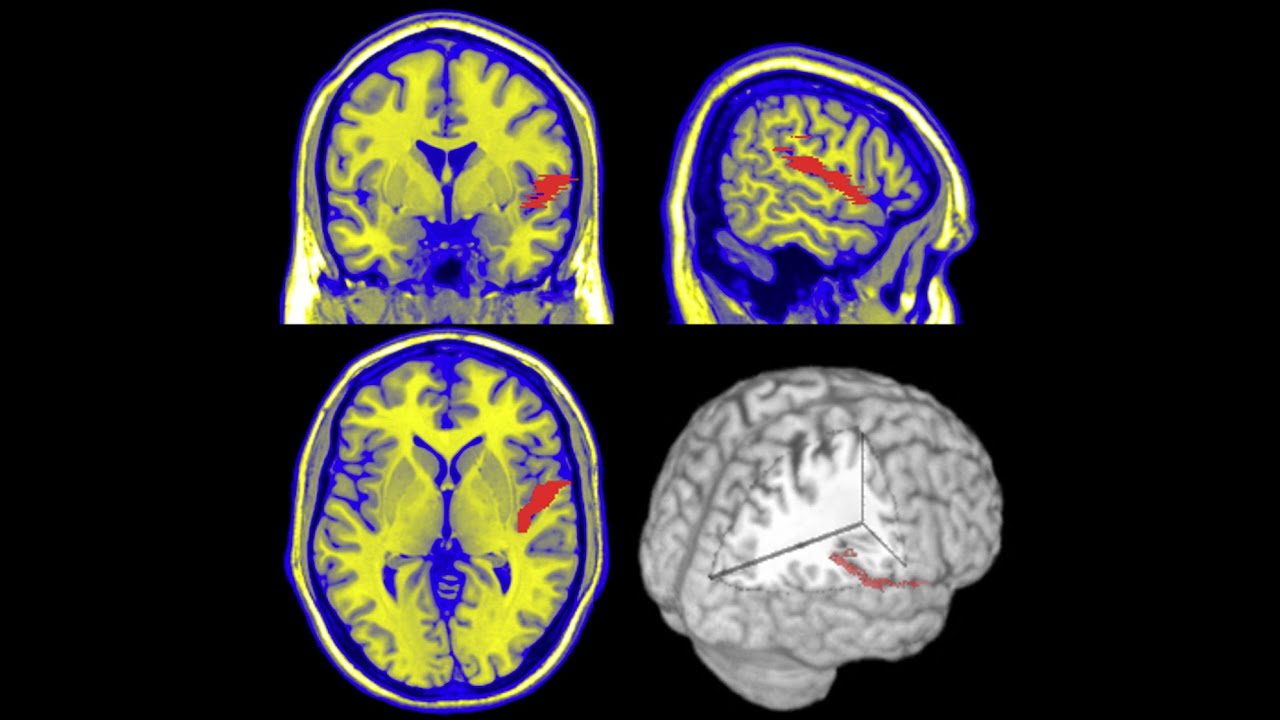 Cortical hearing disorders