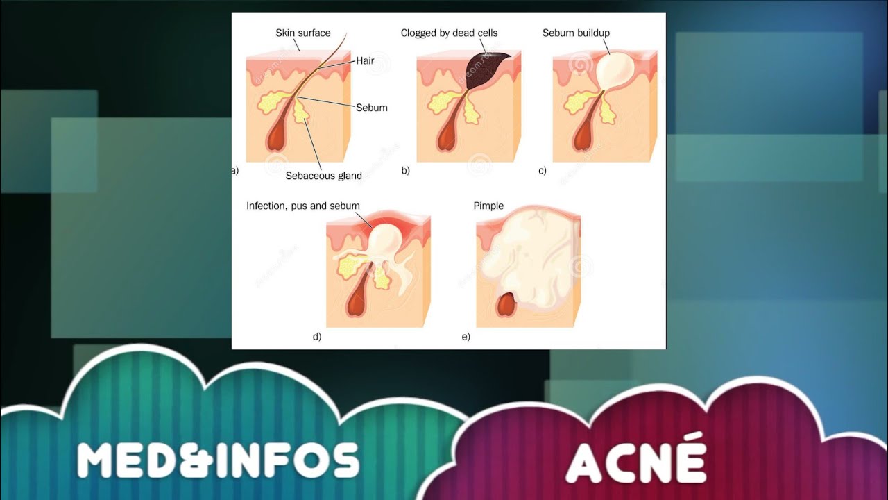 🔵l'Acné  (physiopathlogie+ clinique+traitement)