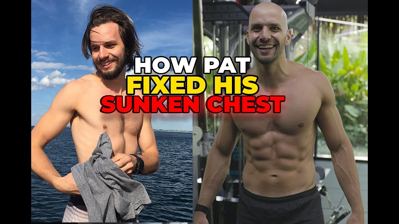 Bullied with a Sunken Chest to Beast! Pats Pectus Excavatum Story