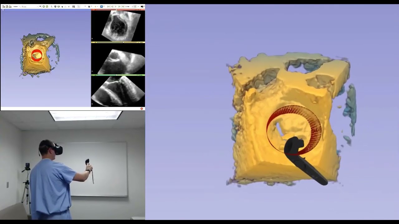 Device Placement in Volume Rendered and Segmented Heart Models using Virtual Reality