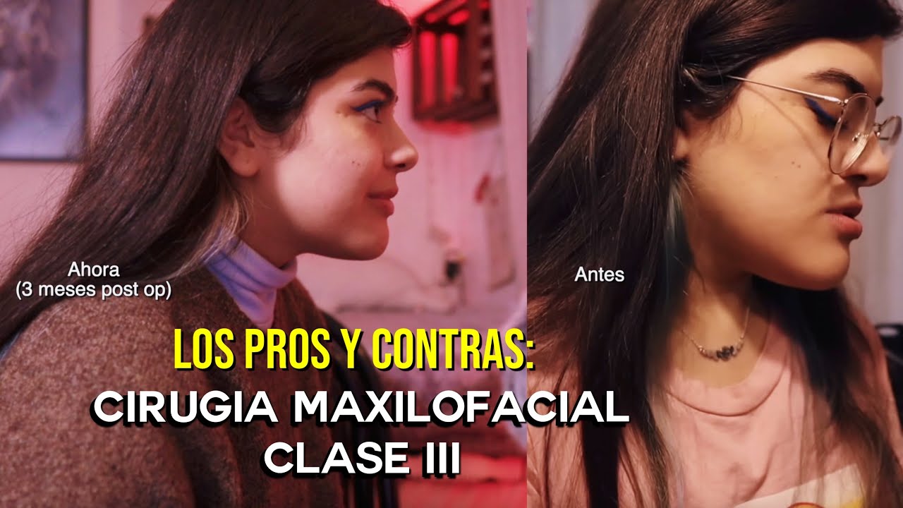 Vlog #3: Complicaciones? Septum desviado 🥲 3 meses POST OP | Cirugía Ortognática Clase III | Chile
