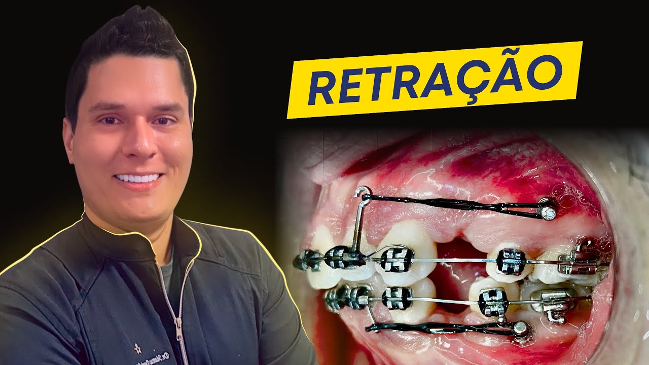 Retração em Ortodontia: Como fazer? (Guia completo).