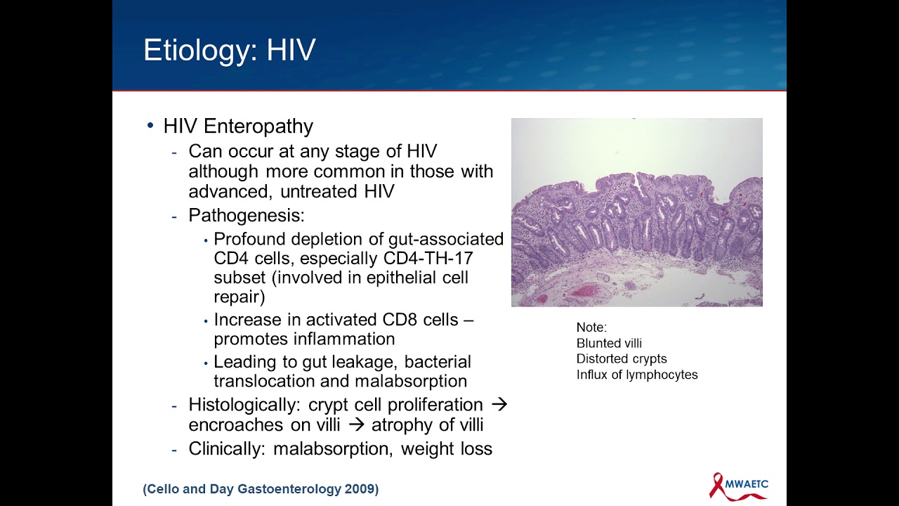 HIV Associated Diarrhea